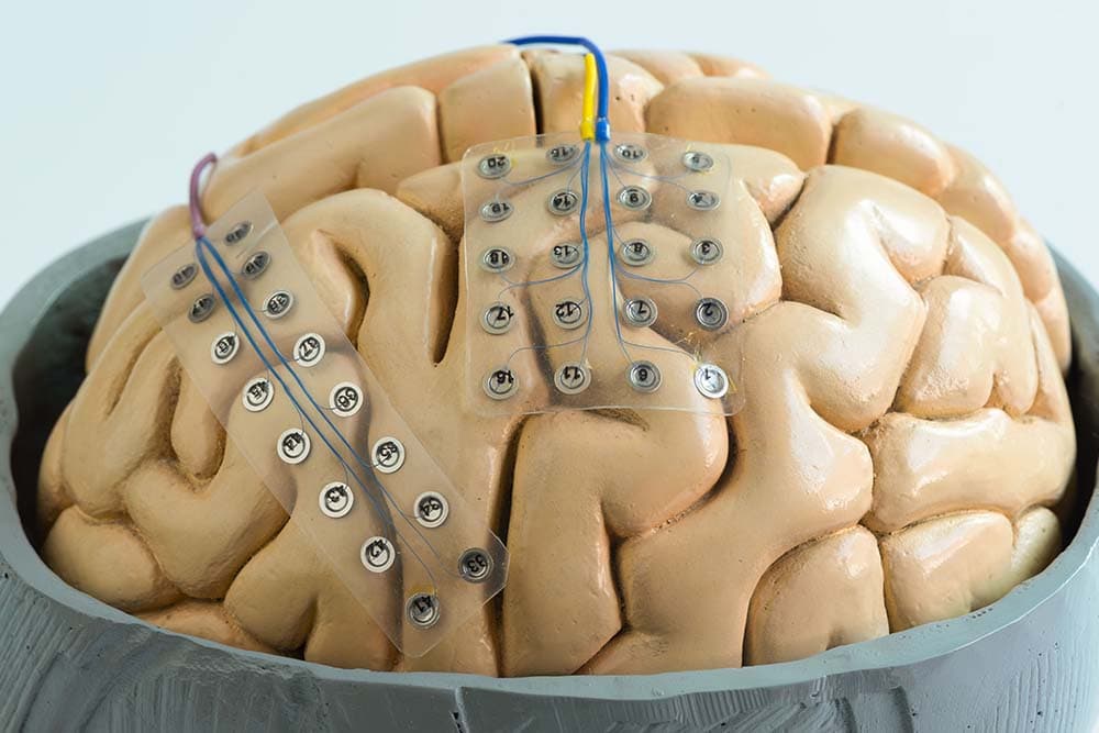 Awake Craniotomy