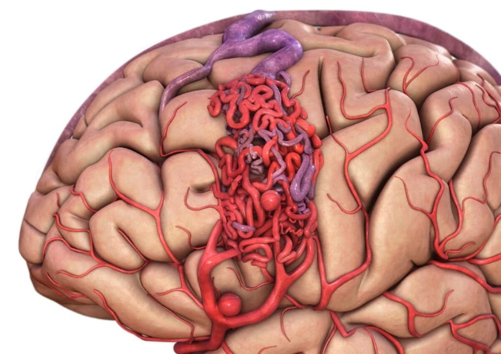 AVM — arteriovenous malformation illustration