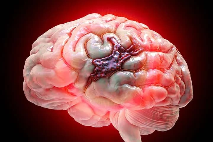 Brain hemorrhage — emergency intracranial bleeding illustration