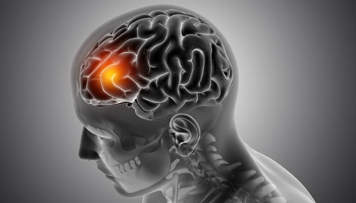 Brain tumors — neurosurgical evaluation illustration