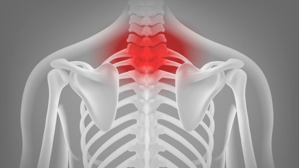 Cervical spondylosis — neck and cervical spine degeneration illustration