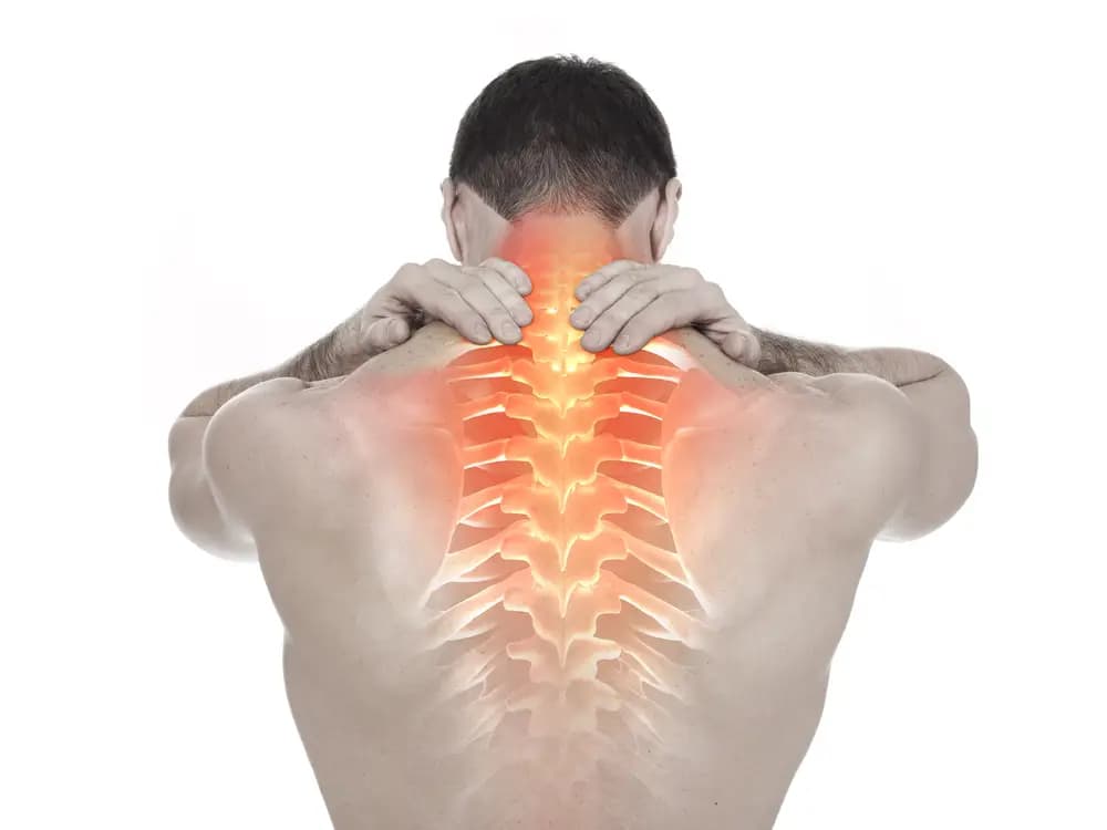 Spinal cord compression — spinal canal narrowing illustration