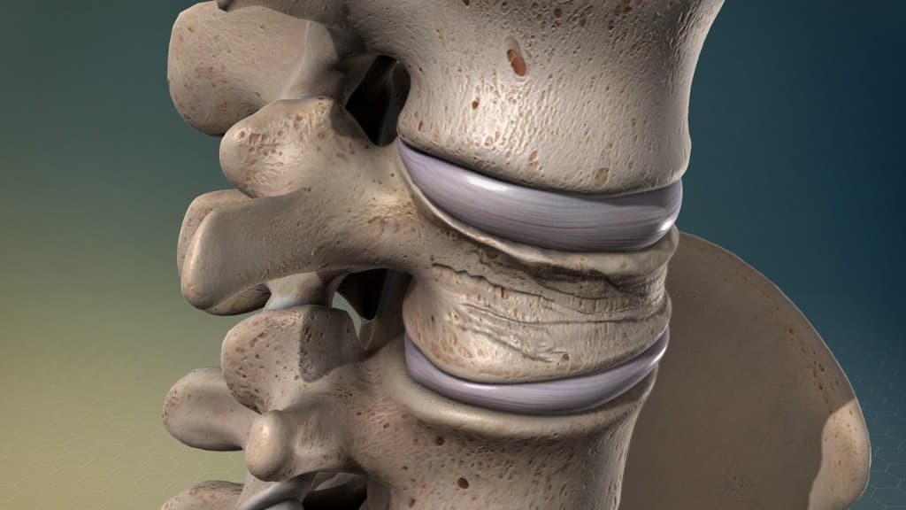 Spine fractures — vertebral trauma illustration