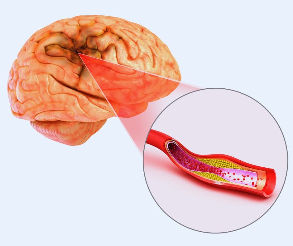 Stroke — acute neurovascular emergency illustration