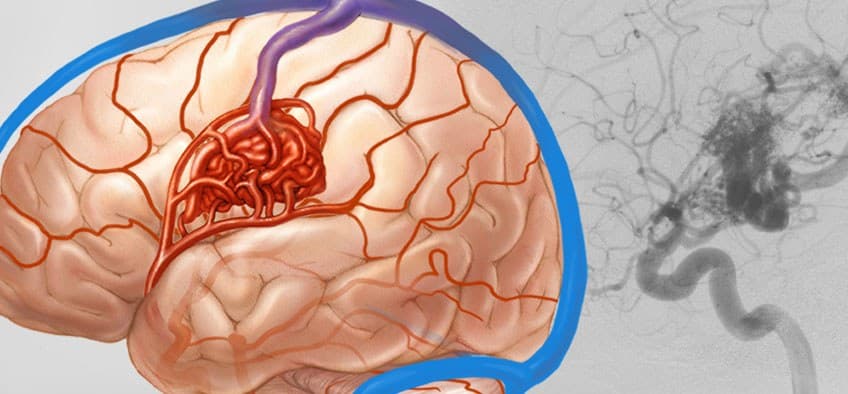 Brain aneurysm and AVM surgery — arteriovenous malformation illustration