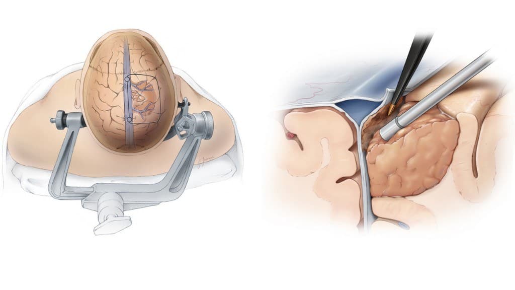 Brain tumor surgery — craniotomy and tumor resection illustration