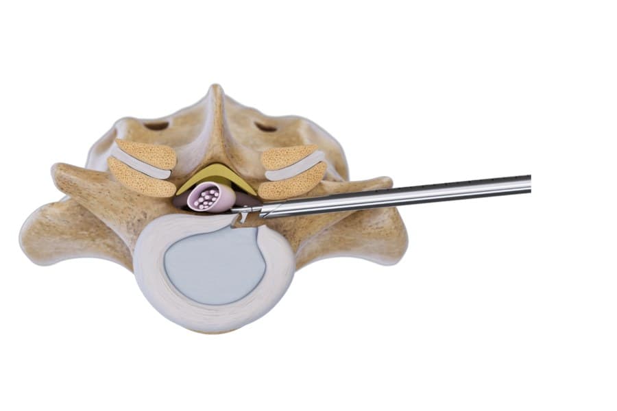 Endoscopic spine surgery — minimally invasive RIWO illustration