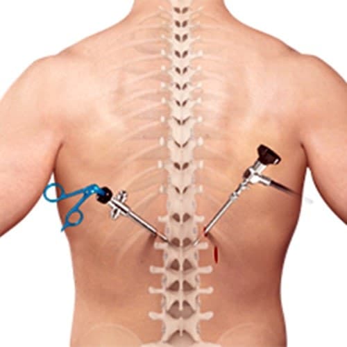 Minimally invasive spine surgery — tubular decompression illustration