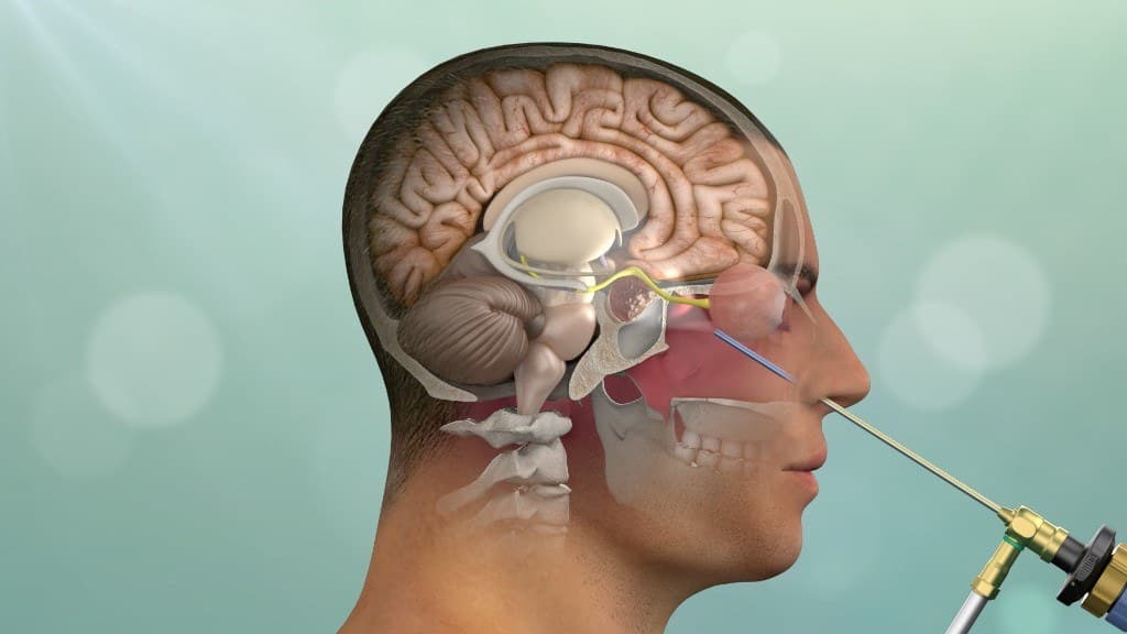 Skull base surgery — endonasal transsphenoidal approach illustration