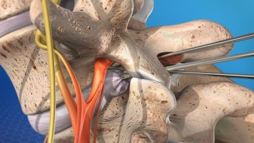 Slip disc surgery — microdiscectomy and nerve decompression illustration