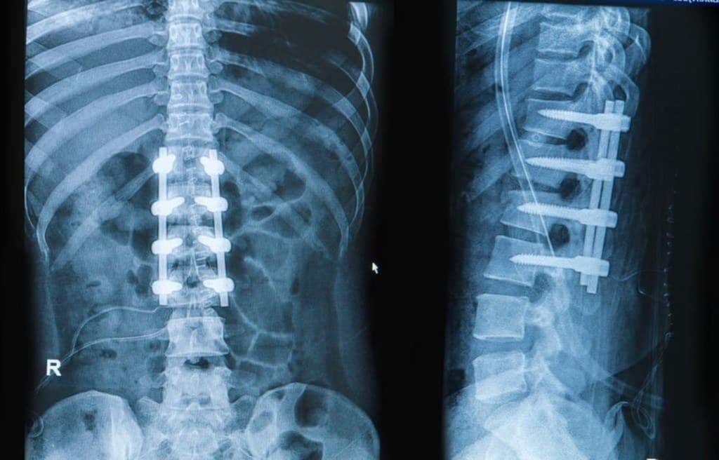 Spinal fusion — vertebral stabilisation and instrumentation illustration