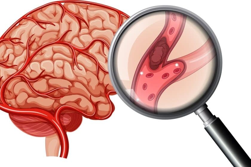 Stroke intervention — cerebral ischemia and vessel occlusion illustration
