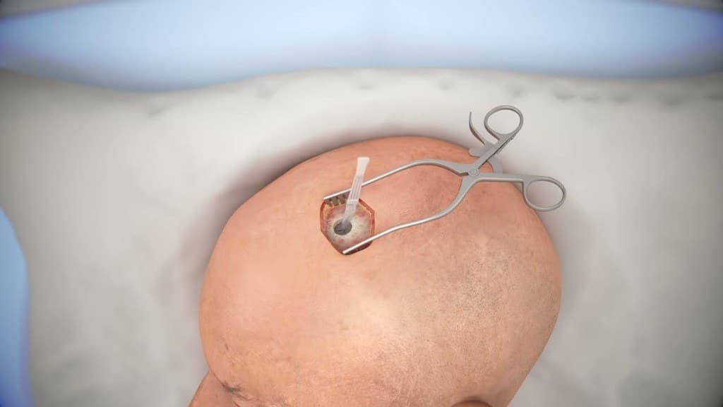 VP shunt surgery — ventricular catheter and CSF diversion illustration