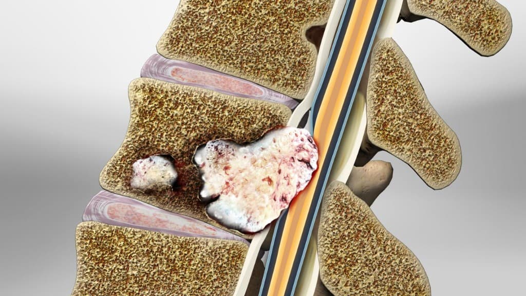 Spinal tumors — vertebral and spinal cord tumor illustration