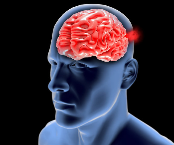 Brain aneurysm — cerebral vascular malformation illustration