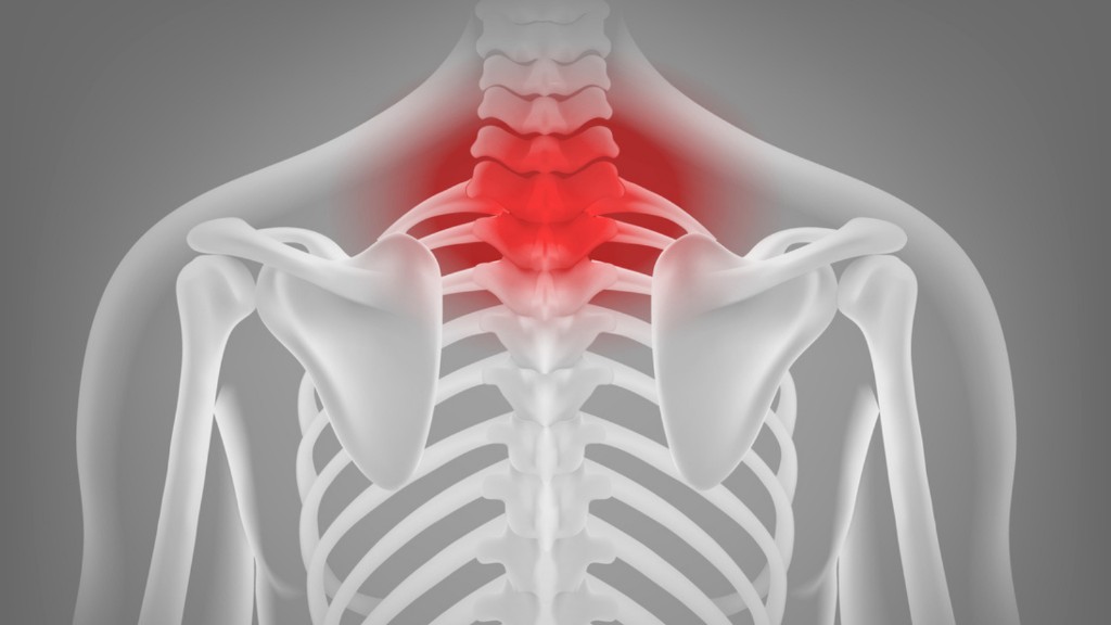 Cervical spondylosis — neck and cervical spine degeneration illustration