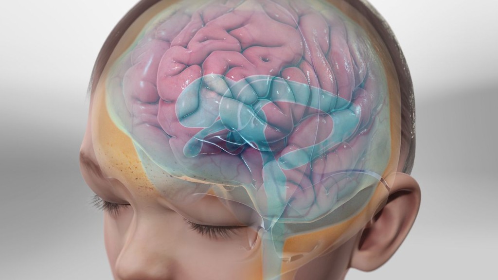Hydrocephalus — cerebrospinal fluid and ventricular enlargement illustration