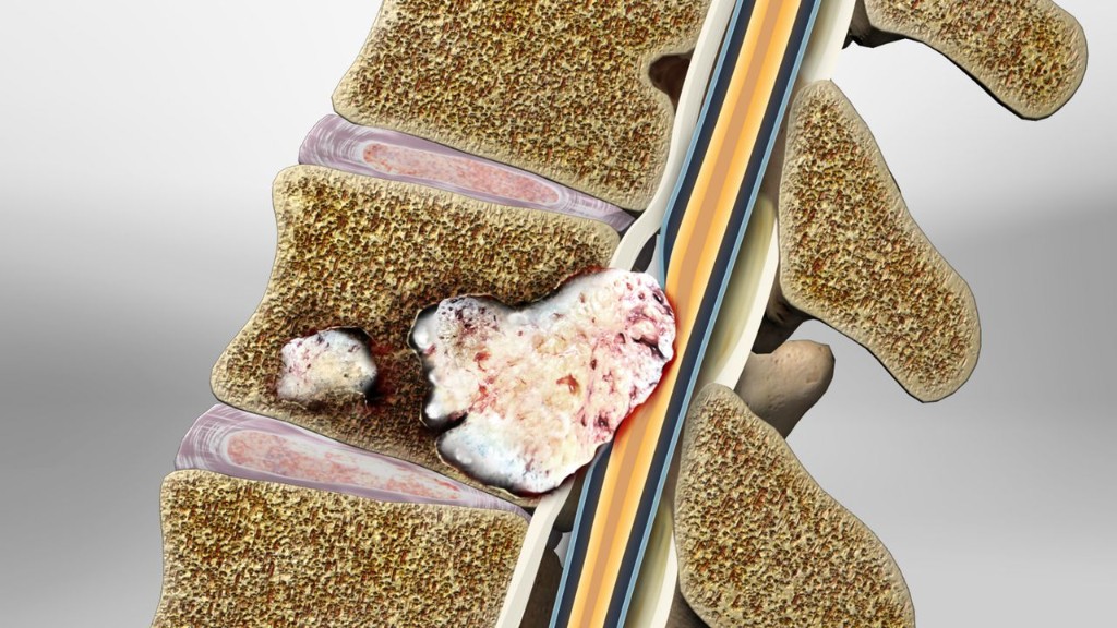 Spinal tumors — vertebral and spinal cord tumor illustration