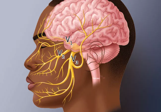 Trigeminal neuralgia — facial nerve pain illustration