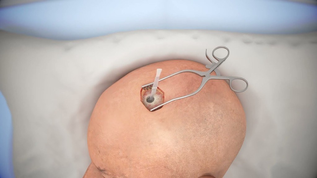 VP shunt surgery — ventricular catheter and CSF diversion illustration